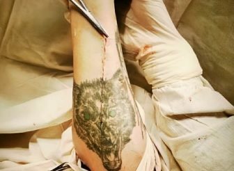 Ульяновские врачи сохранили пациенту татуировку после операции на руку